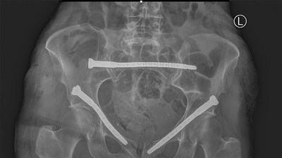Curvafix (140mm) screw placed and locked at the sacral region, with screws of 110 mm and 100 mm at the superior and inferior pubic ramus fractures